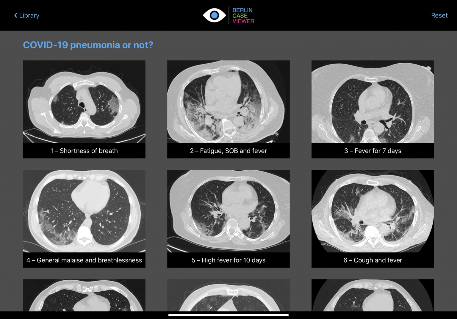 Detection of COVID-19 on CT Scans: BerlinCaseViewer as a Training Tool during the Current Coronavirus Pandemic