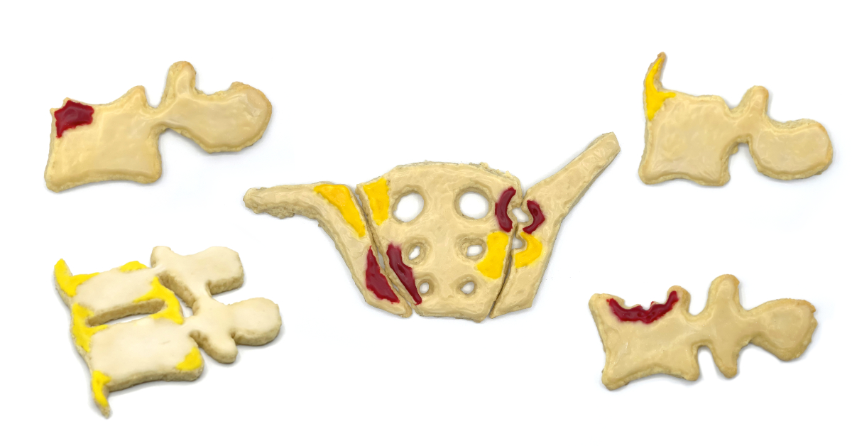 Die Weihnachtsvorlesung zu axialer Spondyloarthritis zum Anbeißen