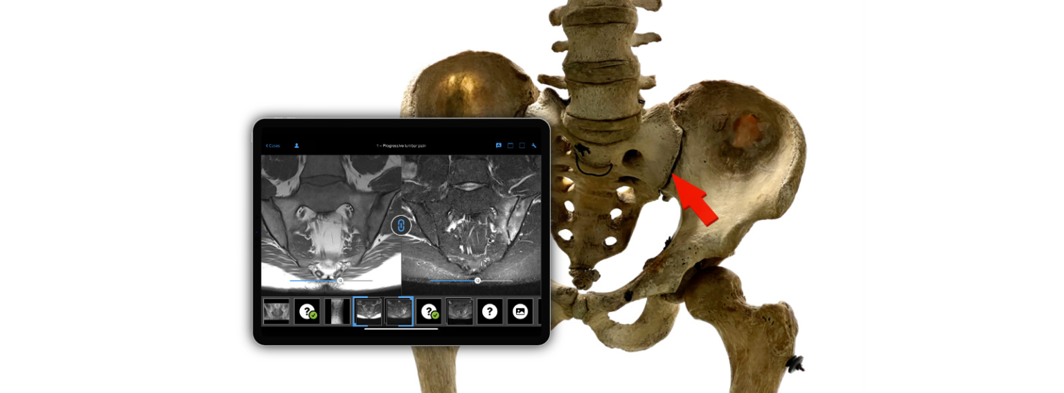 Diagnosis of Axial Spondyloarthritis – Interview with Joachim Sieper (Part 1)