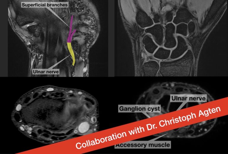 MRI of the ulnar nerve