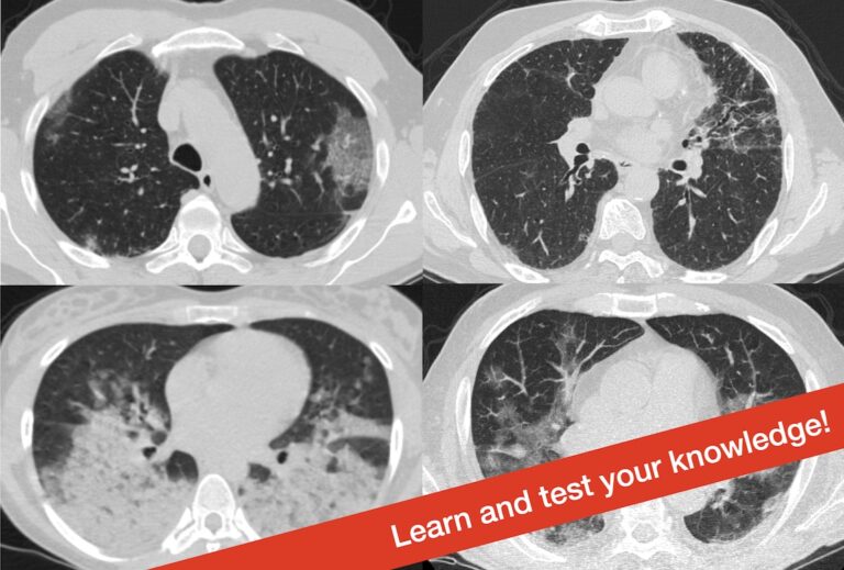 Imaging of viral pneumonia and its differentials