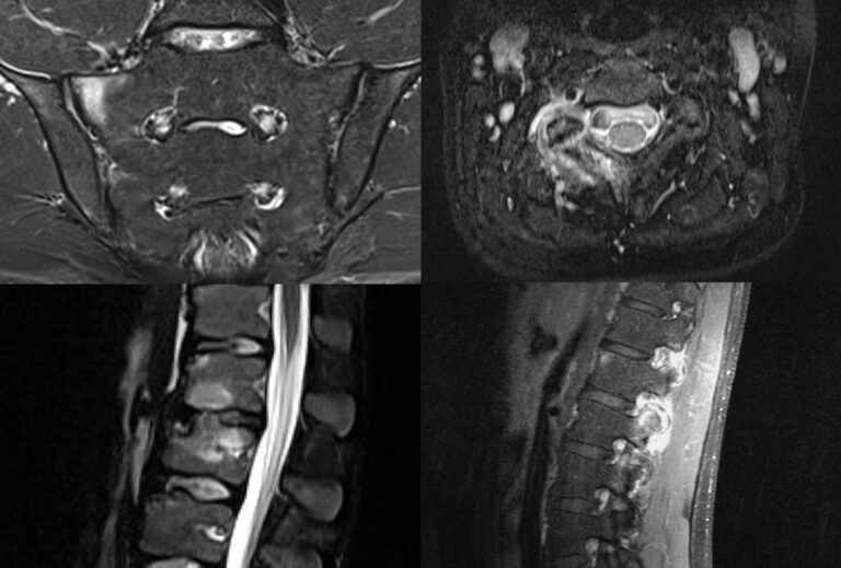 Pitfalls on MRI of the axial skeleton