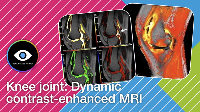 DCE MRI of the knee