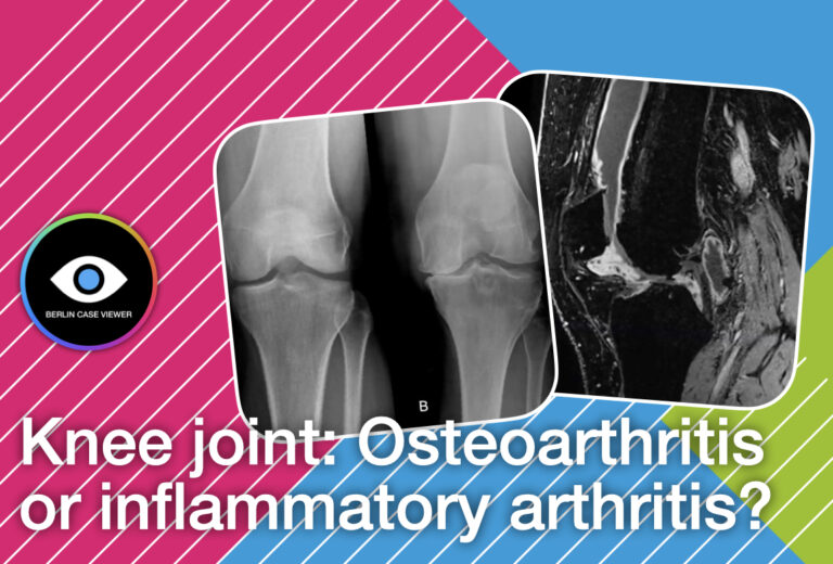 Knee imaging – osteoarthritis vs. rheumatoid arthritis