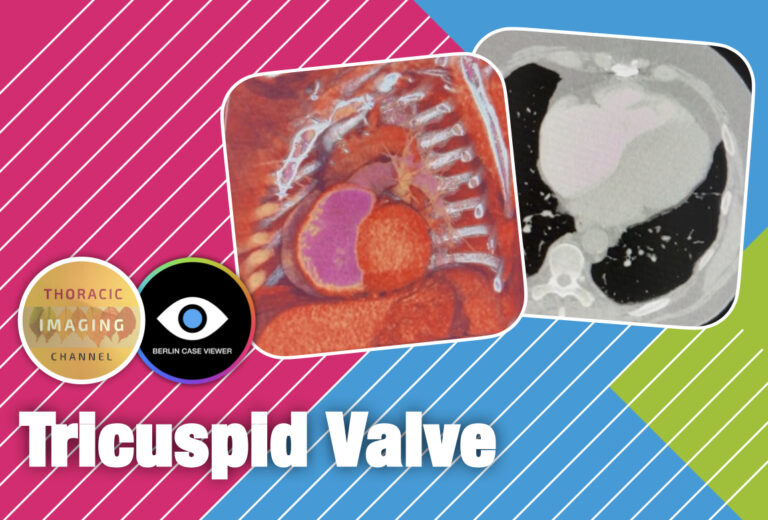 Cardiac CT: Tricuspid valve